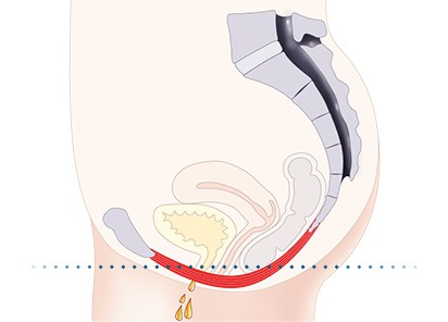 Pelvic-Floor Muscle Repair 5 Pelvic floor muscles Little Bognor
