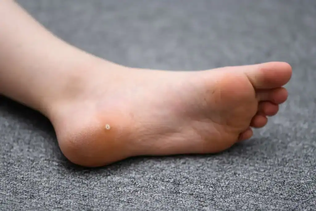 Cryotherapy For Warts And Also Verrucas 2 Image of verruca on the bottom of the foot that able to be treated with Cryotherapy Little Bognor