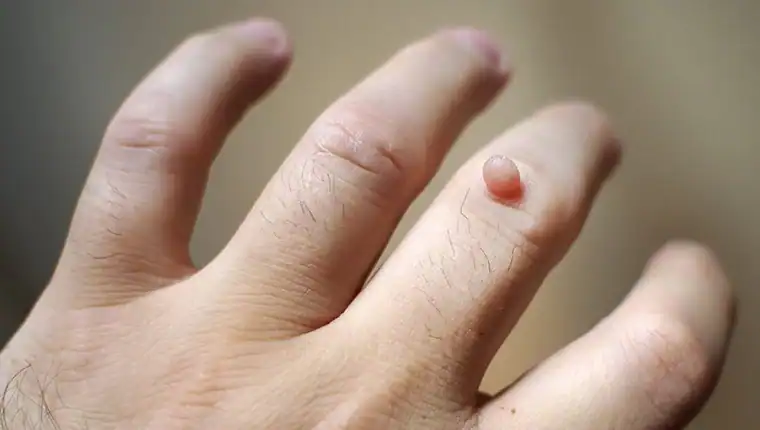 Image of blemish that Cryotherapy Little Bognor can remove with Lipo 360.